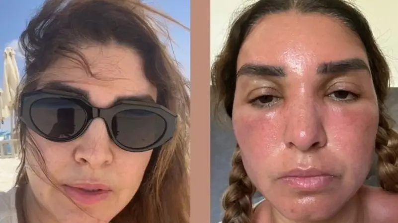 حروق وتضخم بالوجه روجينا تكشف تفاصيل ما حدث لوجهها 2 روجينا تكشف تفاصيل ما حدث