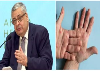 حقيقة دخول جدري القرود لمصر مستشار الرئيس للشئون الصيحة يحسم الجدل
