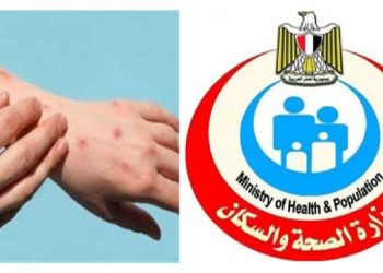 الصحة تعلن طرق انتقال جدري القرود من شخص إلى اخر وترفع درجة الاستعداد القصوي