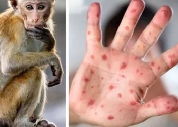 الصحة تجيب كيفية علاج مريض جدري القرود وما هى الأدوية المستخدمة