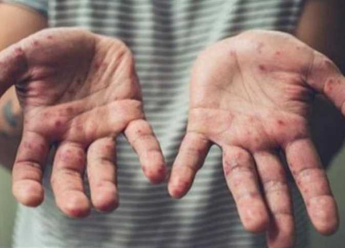 الصحة العالمية تصدر بيان عاجل بشأن جدري القرود 2 وباء جدري القرود