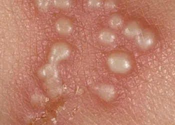 فيروس الهربس التجريبي