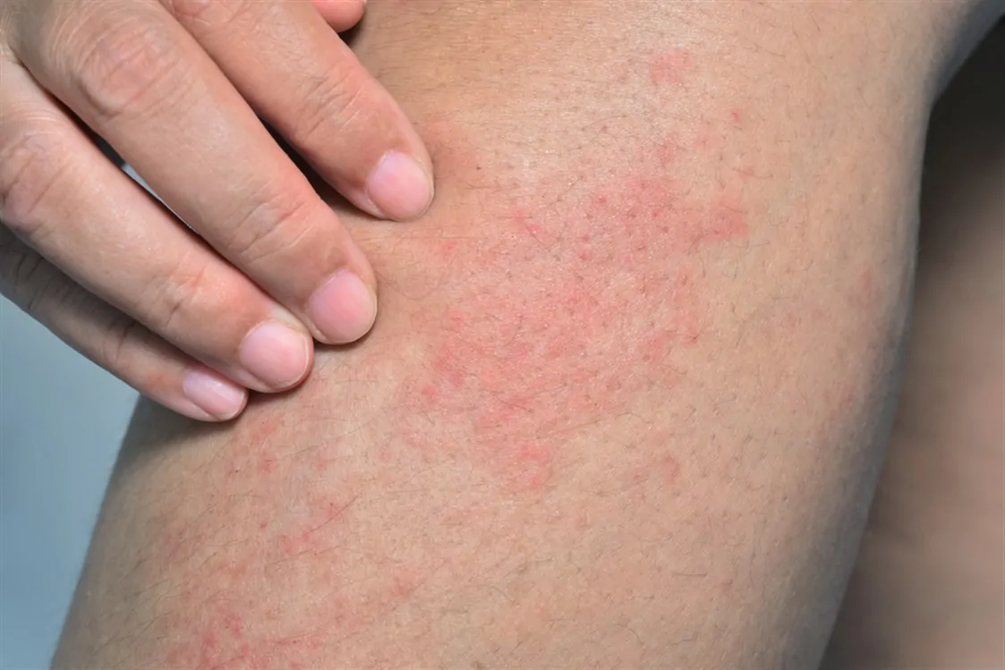 ما هي أسباب وأعراض متلازمة الجلد المحمص وكيفية علاجها 2 متلازمة الجلد المحمص