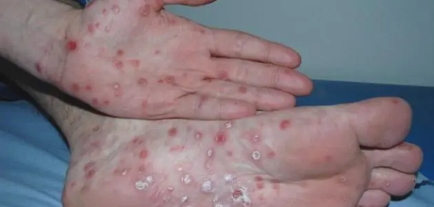 منظمة الصحة العالمية تحذر من مرض خطير معدي يهدد المتزوجين لا يتشافون منه 3 منظمة الصحة العالمية