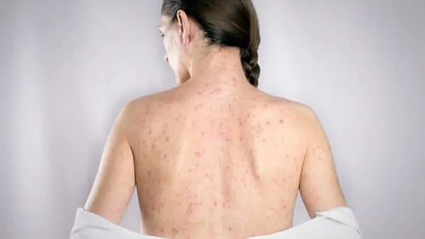 منظمة الصحة العالمية تحذر من مرض خطير معدي يهدد المتزوجين لا يتشافون منه 5 مرض الزهري