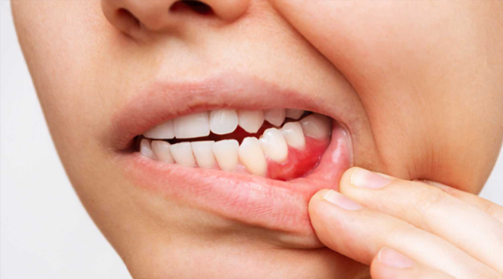 أعراض خطيرة للسرطان تلاحظ عند تنظيف الأسنان 2 أعراض خطيرة للسرطان