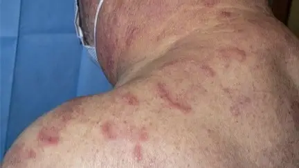 كل ما تحتاج معرفته عن مرض فيكساس VEXAS عقب ظهور أول حالة في مصر 3 متلازمة مرض فيكساس VEXAS
