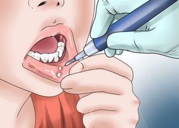 القضاء على قرح الفم وصفات طبيعية فعّالة من المنزل 8 قرح الفم
