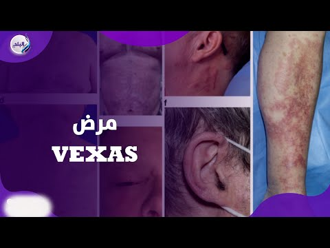 كل ما تحتاج معرفته عن مرض فيكساس VEXAS عقب ظهور أول حالة في مصر 4 متلازمة مرض فيكساس VEXAS