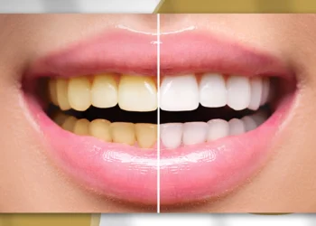 طريقة تحضير وصفة طبيعية لتبييض الأسنان من أول استخدام للحصول على ابتسامة مشرقة