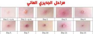 بالصور تعرف على شكل الجدري المائي وأعراضه رصد 6 حالات بين الطلاب 4 الجدري المائي