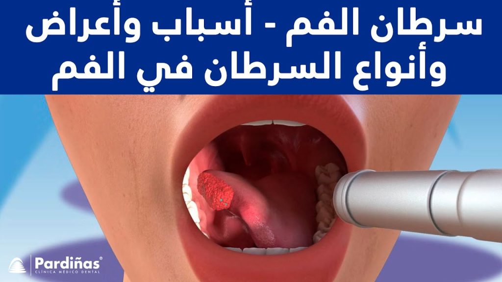ماهو سرطان الفم أعراضه وطرق علاجه وتشخيصه 3 سرطان الفم