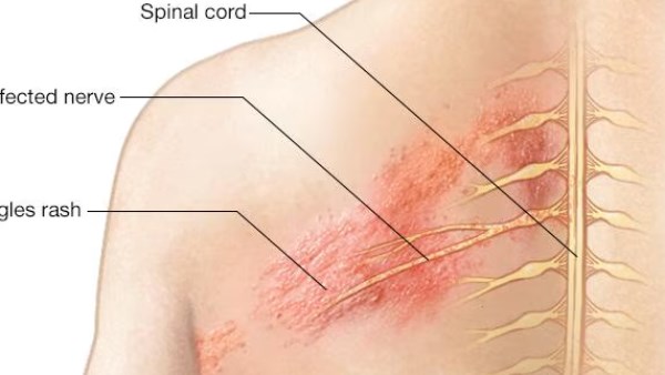 أعراض وأسباب الحزام الناري مرض صامت يهدد كبار السن اعرف طرق الوقاية 2 الحزام الناري