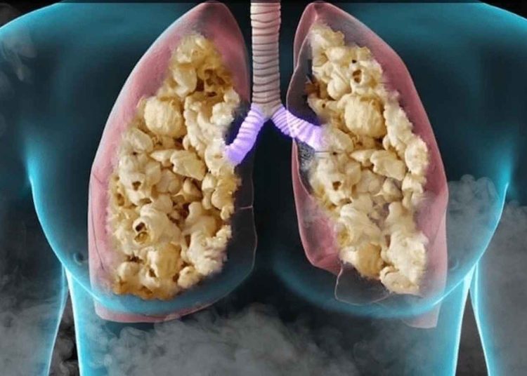 مرض رئة الفشار أعراضه ومراحل خطورته 1 مرض رئة الفشار