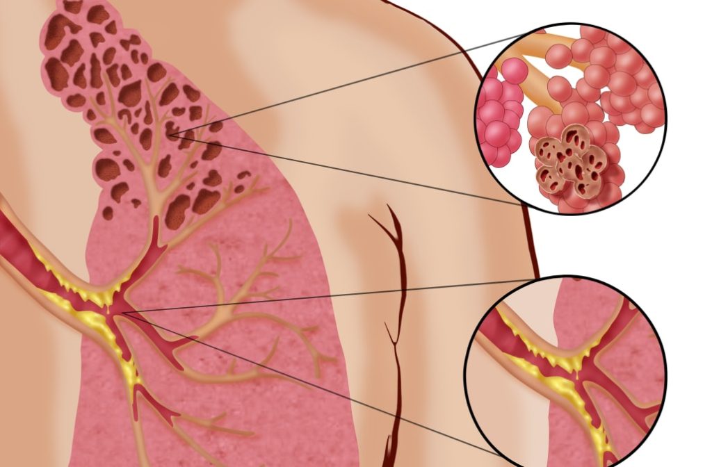 مرض رئة الفشار أعراضه ومراحل خطورته 3 مرض رئة الفشار