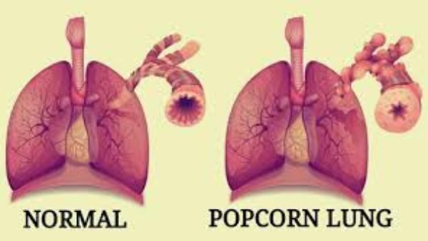 مرض رئة الفشار أعراضه ومراحل خطورته 4 مرض رئة الفشار