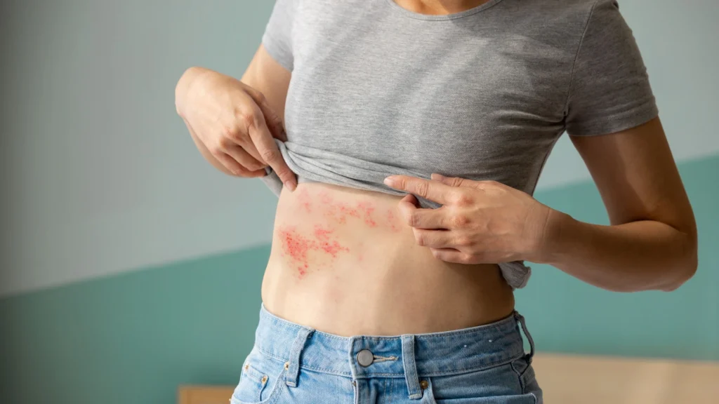 أعراض وأسباب الحزام الناري مرض صامت يهدد كبار السن اعرف طرق الوقاية 4 الحزام الناري