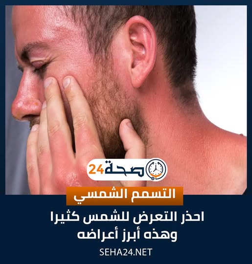التسمم الشمسي أعراض شديدة تتجاوز حروق الشمس ووسائل علاجها المتنوعة 2 التسمم الشمسي