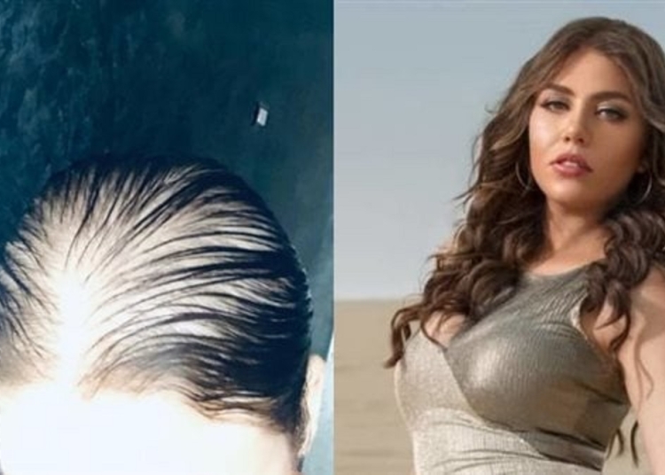 طريقة علاج الصلع نهائيًا طبيب شهير يكشف 5 حلول سحرية بعد إصابة الفنانة رحمة حسن 1 طريقة علاج الصلع