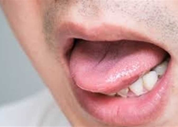 علاجات منزلية لحرق اللسان