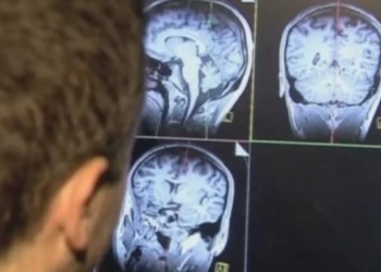 تحذير من سرطان الدماغ 7 أعراض لا تتجاهلها أذهب للطبيب فورا 10 سرطان الدماغ