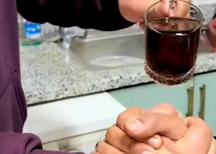 حروق وتشوهات كيف يهدد تحدي الشاي المغلي حياة المراهقين 1 تحدي الشاي