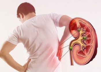 مشروبات تؤدي إلى تكون حصوات الكلى